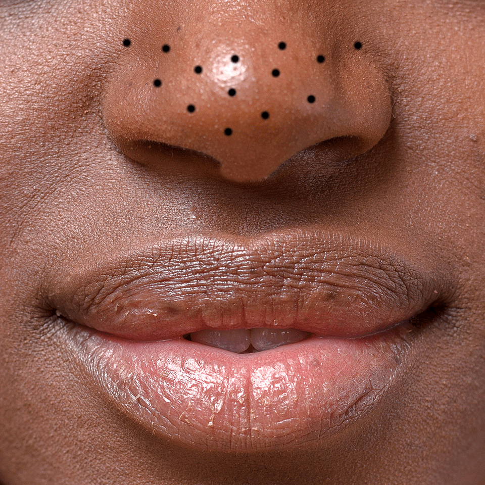 Banish Blackheads On Your Lip Line: Effective Removal Methods
