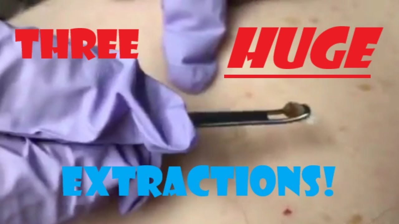 Banishing Backne: Effective Huge Blackhead Removal Techniques
