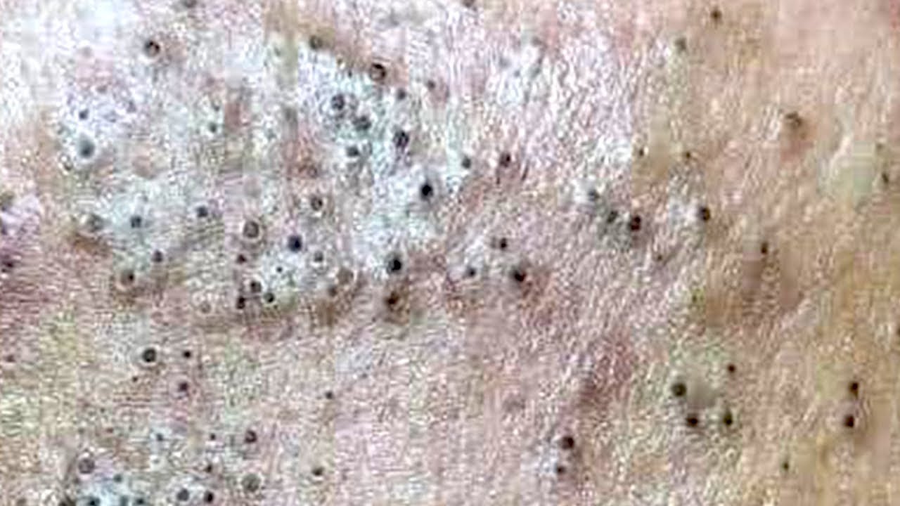Banishing Big Blackhead Pimples: A Guide To Effective Treatment