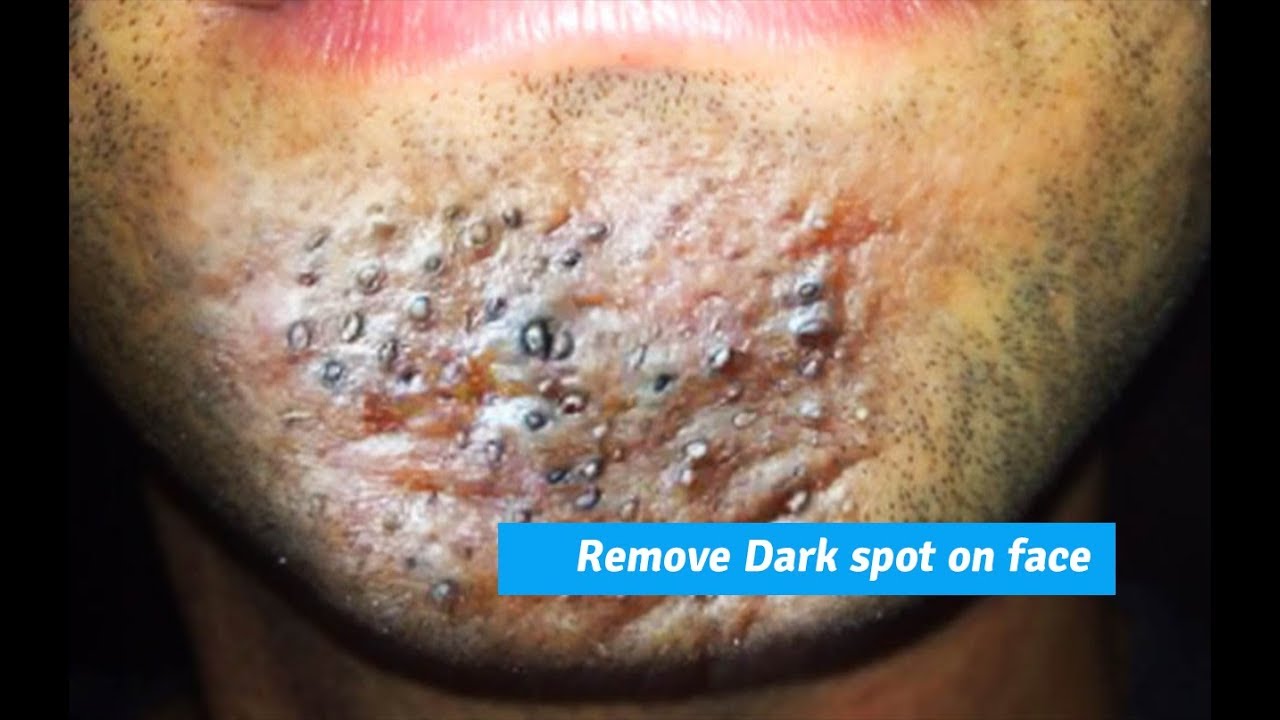 Biggest Blackheads Popped: A Satisfying Compilation Of Extraction Videos
