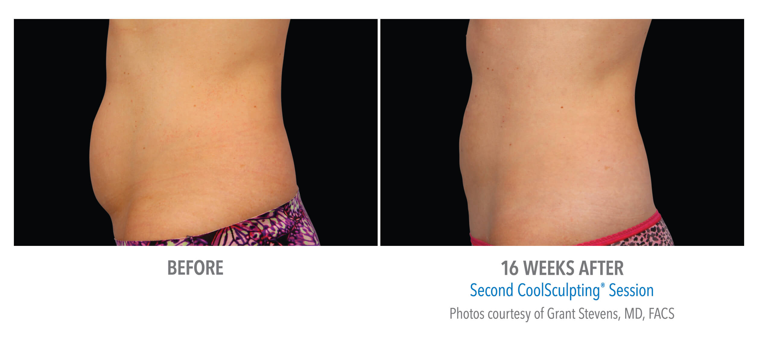 Coolsculpting In Puerto Vallarta: Your Guide To Non-Invasive Fat Reduction