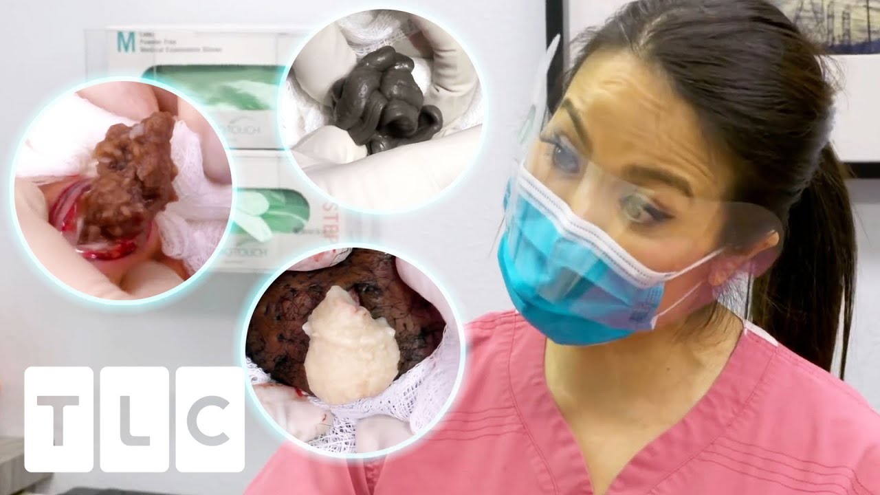 Cyst And Blackhead Popping Videos: A Satisfying Compilation