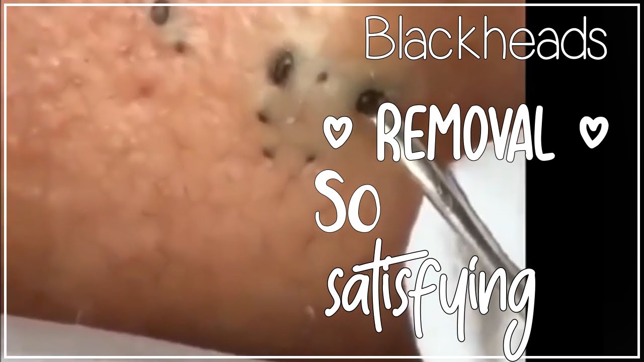 Deep Blackhead Removal Videos 2023: The Ultimate Guide To Clear Skin