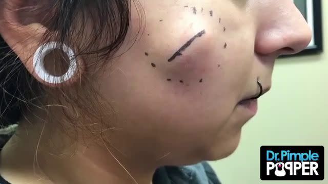 Dr. Pimple Popper's 2023 Blackhead Extractions: What You Need To Know