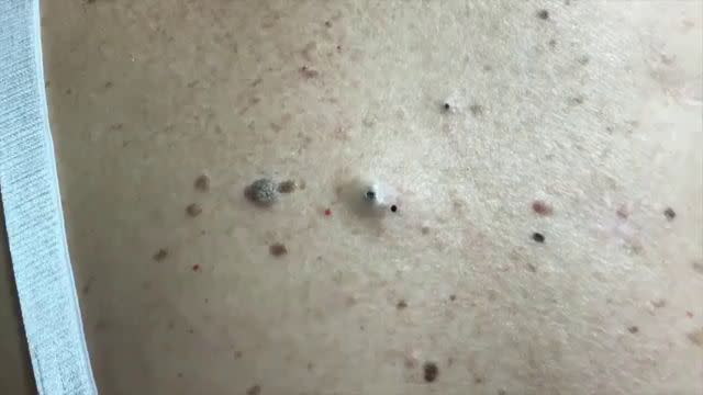 Dr. Pimple Popper's Biggest Blackhead Extractions: A Comprehensive Guide