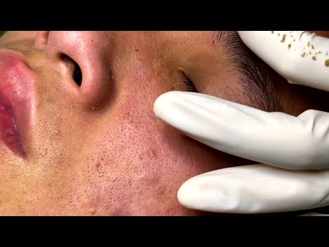 Enilsa Brown Pimple Popping Videos: A Satisfying Compilation