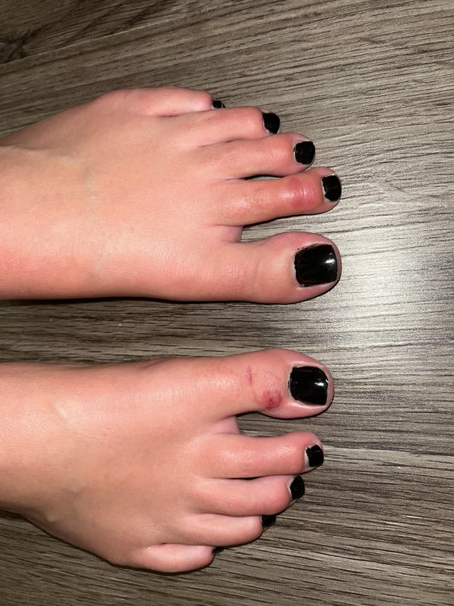 Lamictal Rash Pictures: Identifying And Understanding The Symptoms