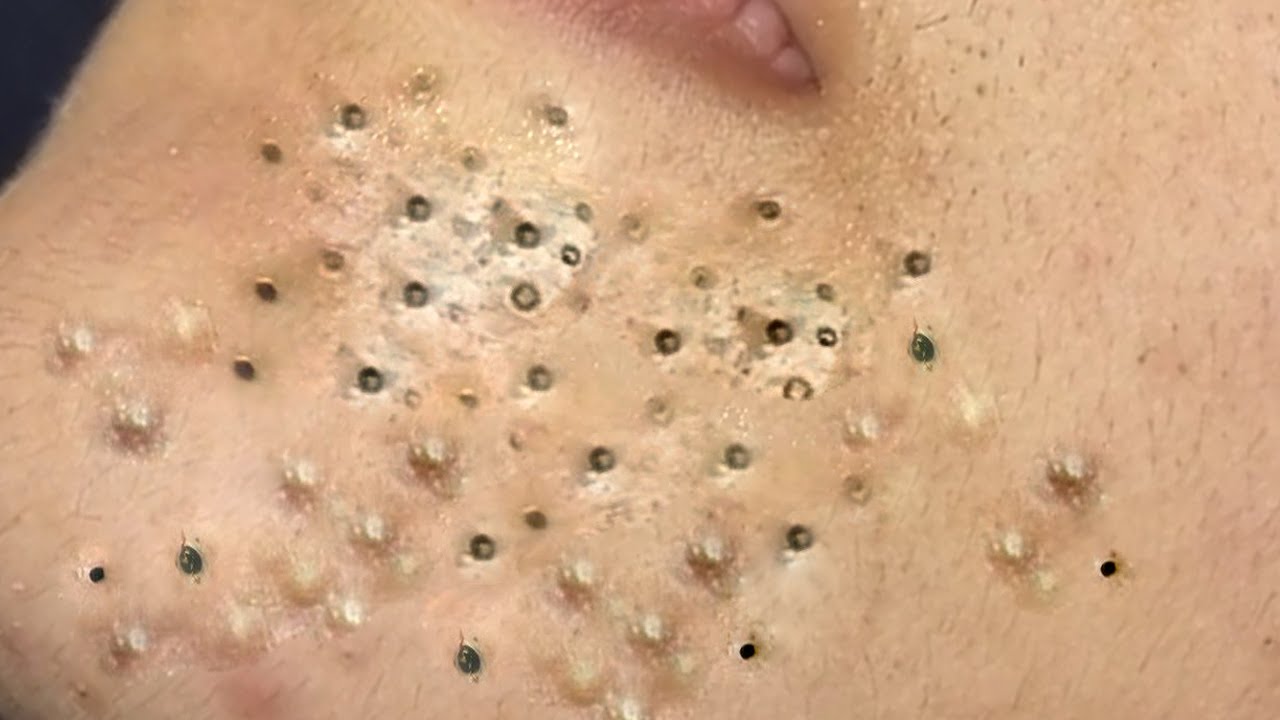Loan Nguyen Spa's Blackhead Extraction Video: 521242