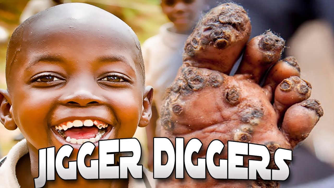 Mastering The Jigger: A Comprehensive Guide To Jigger Digging Videos