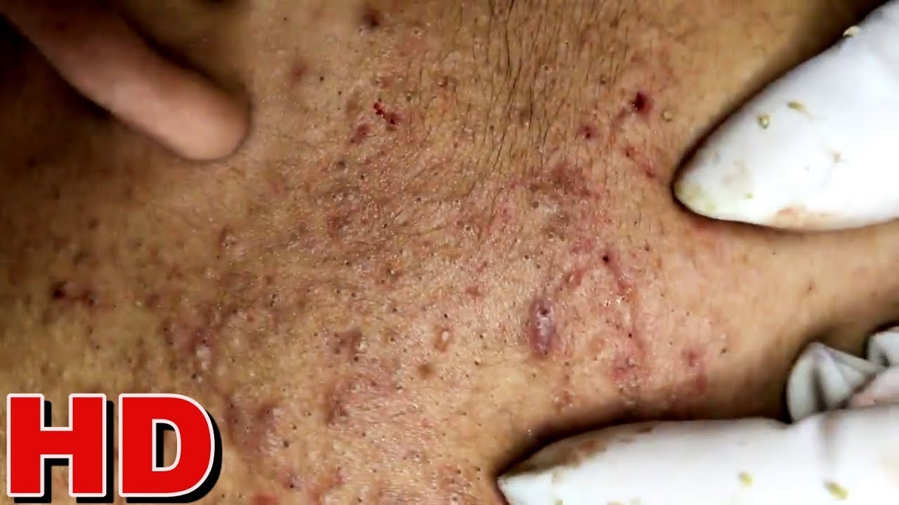 Satisfy Your Curiosity: Newest Blackhead Popping Videos