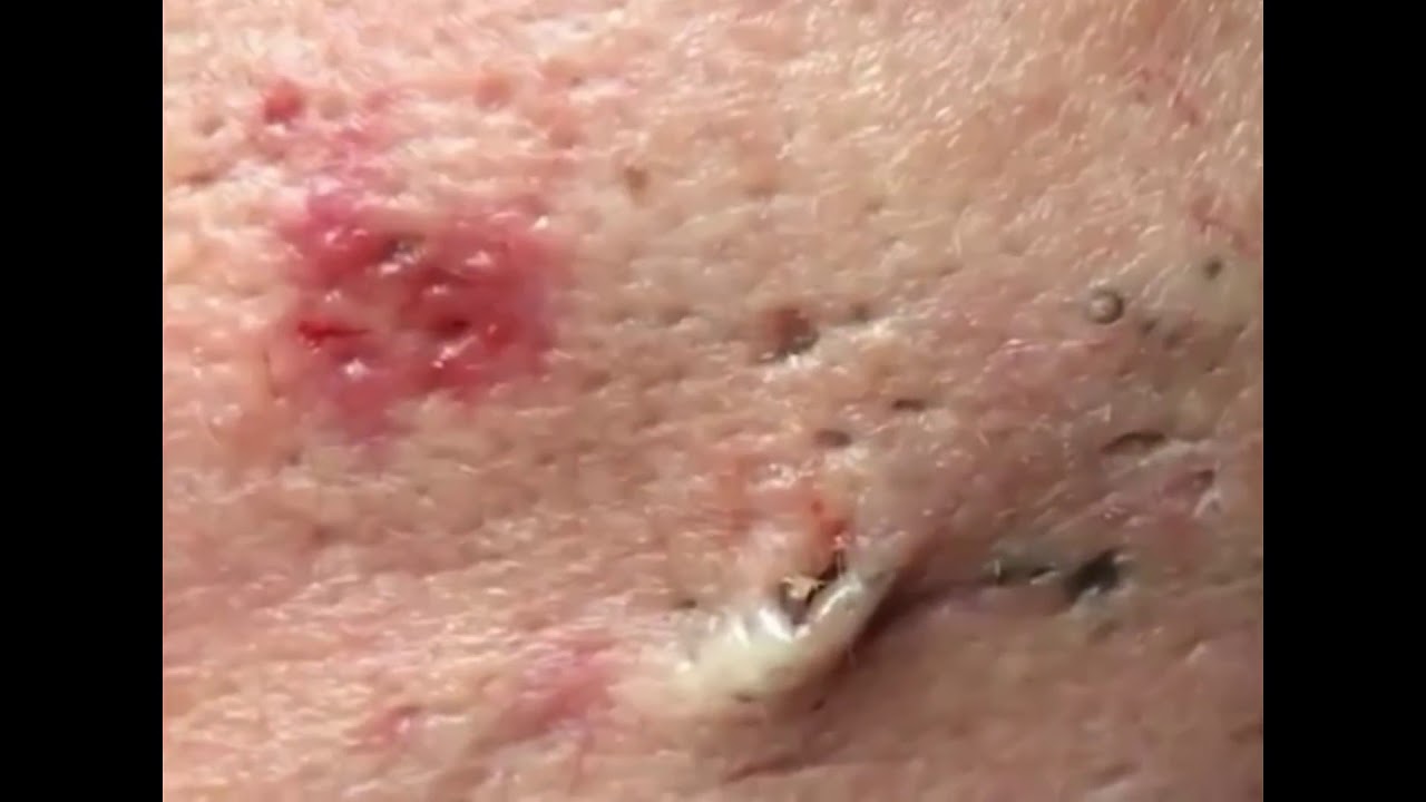 Satisfying Big Blackhead Popping Videos: The Ultimate Compilation