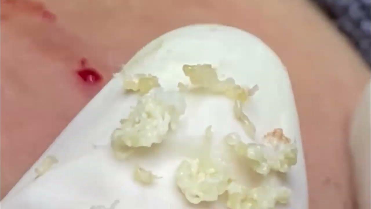 Satisfying Blackhead Popping Videos: The Latest Compilation