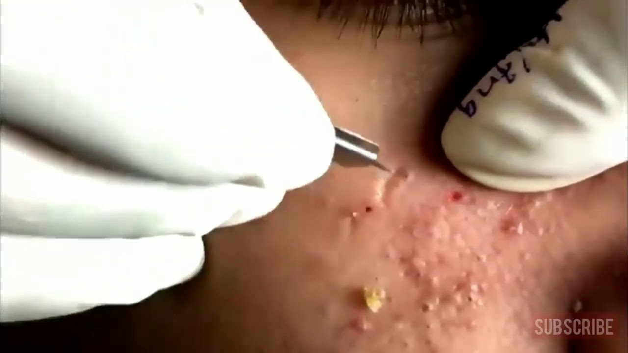 Satisfying Huge Blackhead Removal: Before & After Photos