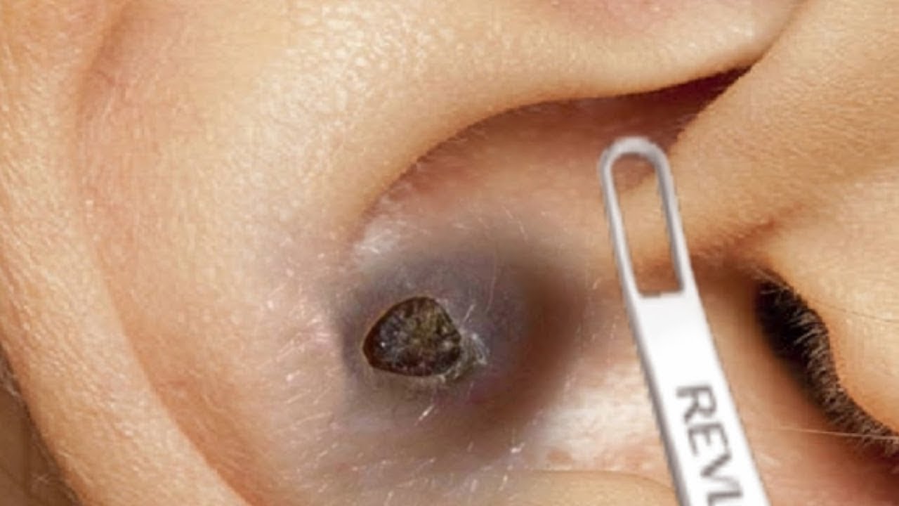 Satisfying Huge Blackhead Removal Videos: Before & After