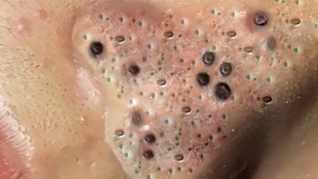 Satisfying Pimple Popping YouTube Videos: A Comprehensive Guide