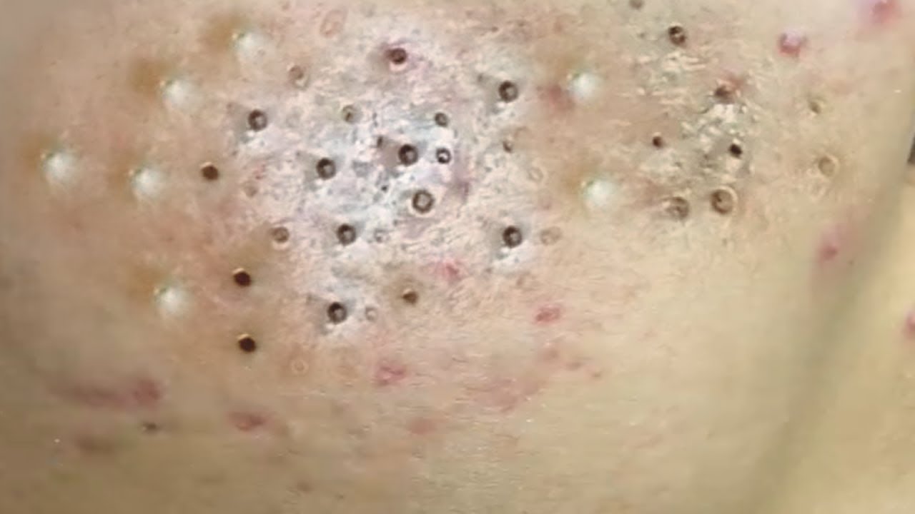 Satisfying Sac Spa Pimple Popping: A Deep Dive Into Extraction Techniques