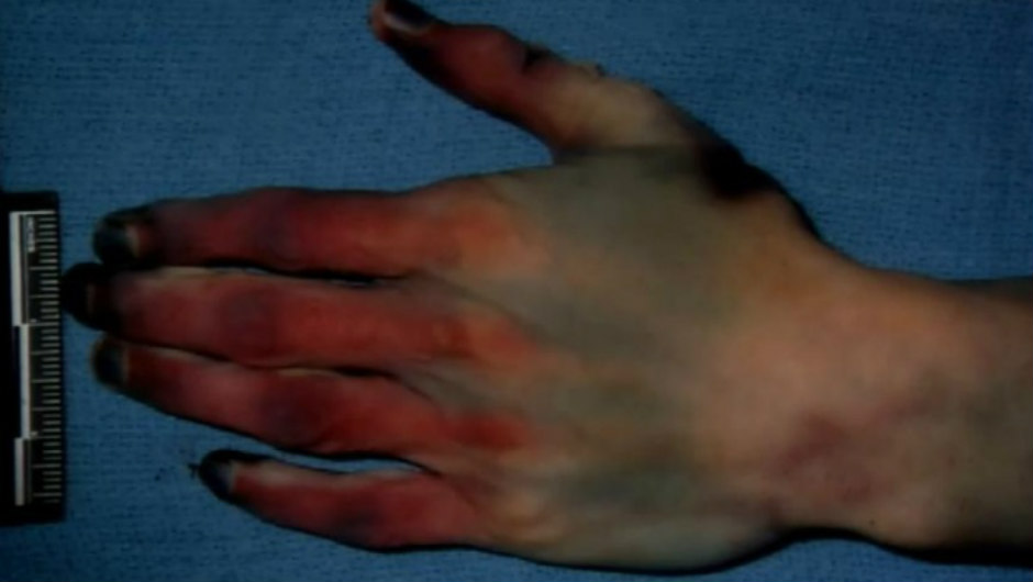 Travis And Jodi: A Comprehensive Look At The Autopsy Findings