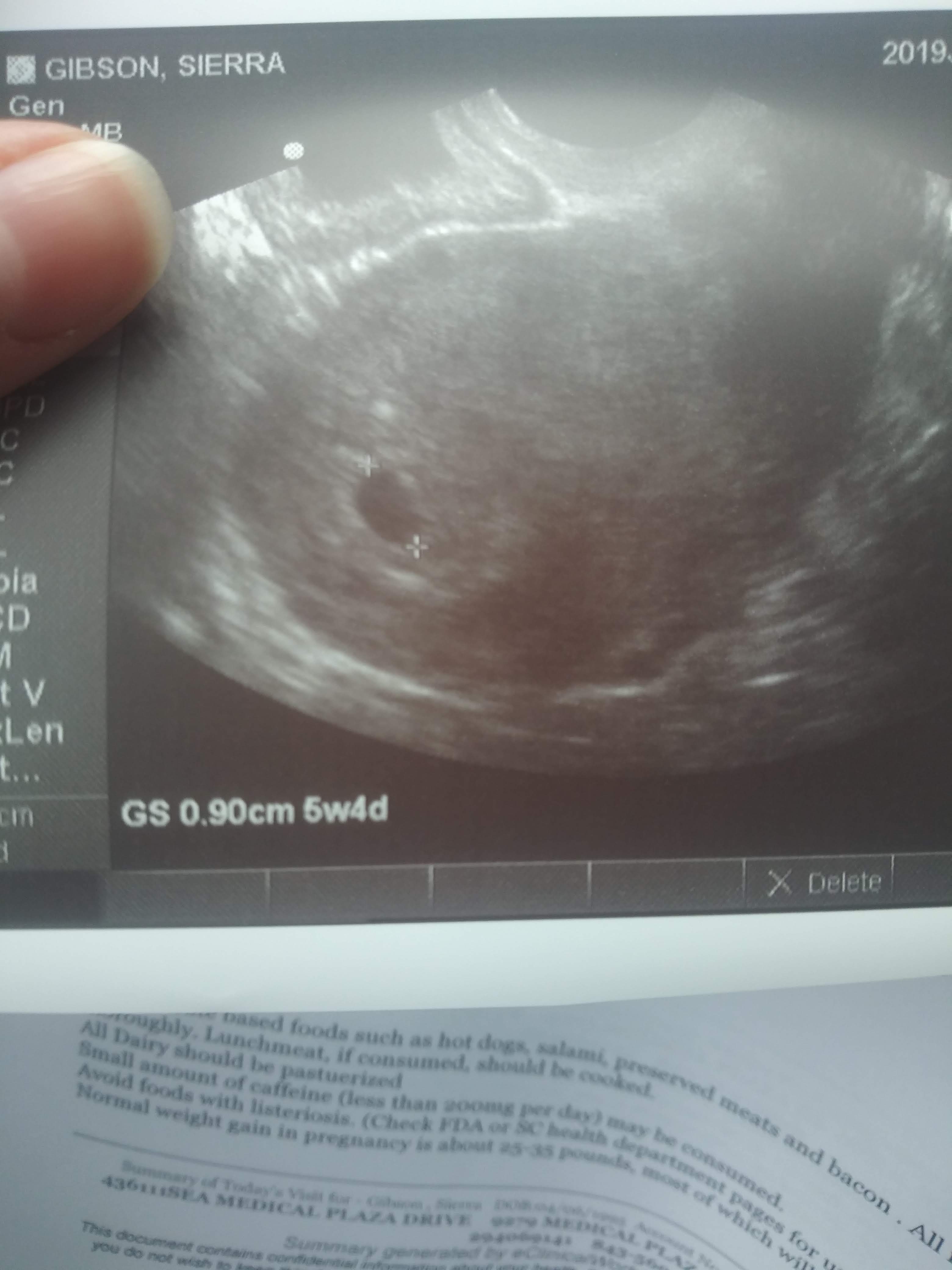 Understanding Empty Sac Pregnancy: A Guide For Expectant Mothers